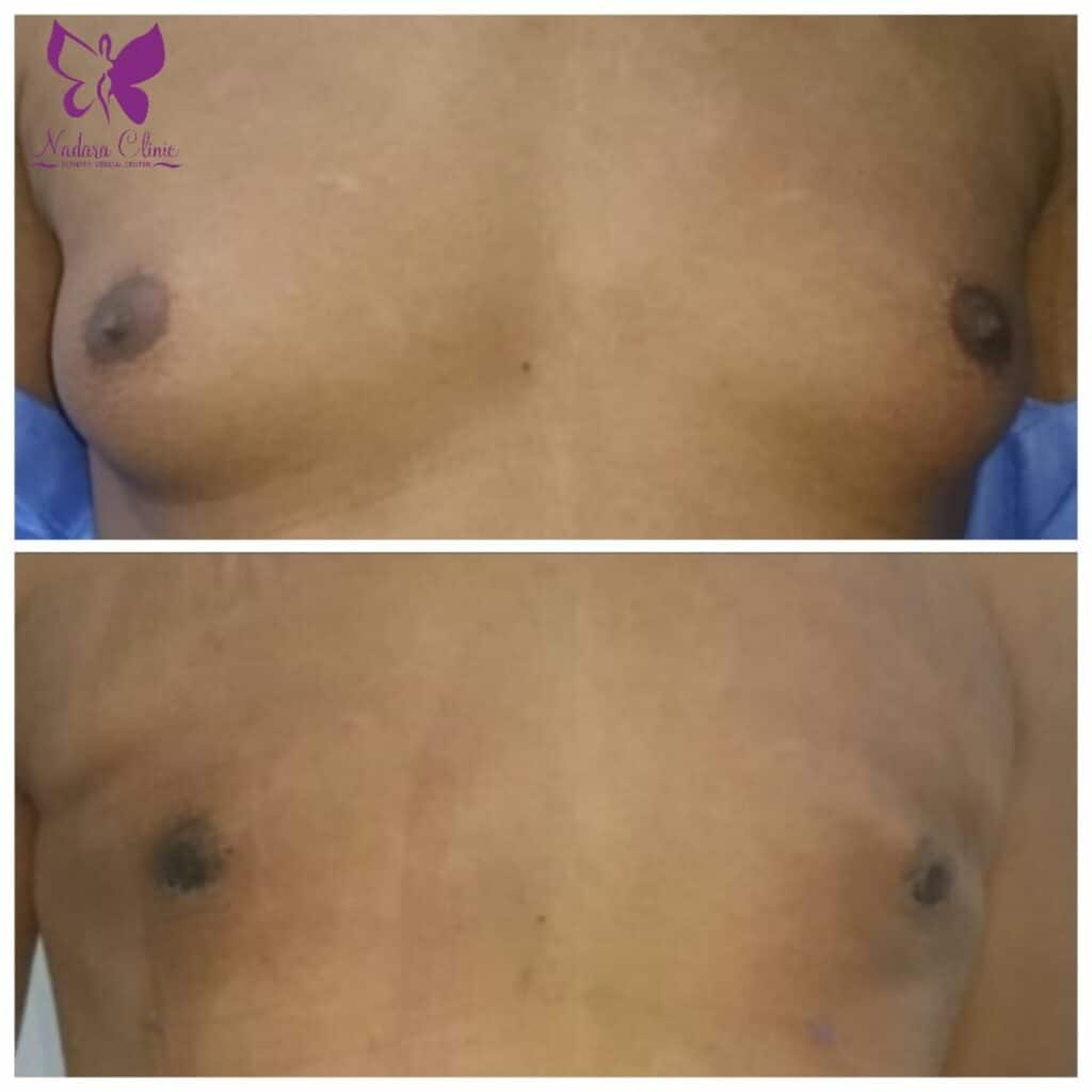 Gynecomastia treatment in Hurghada